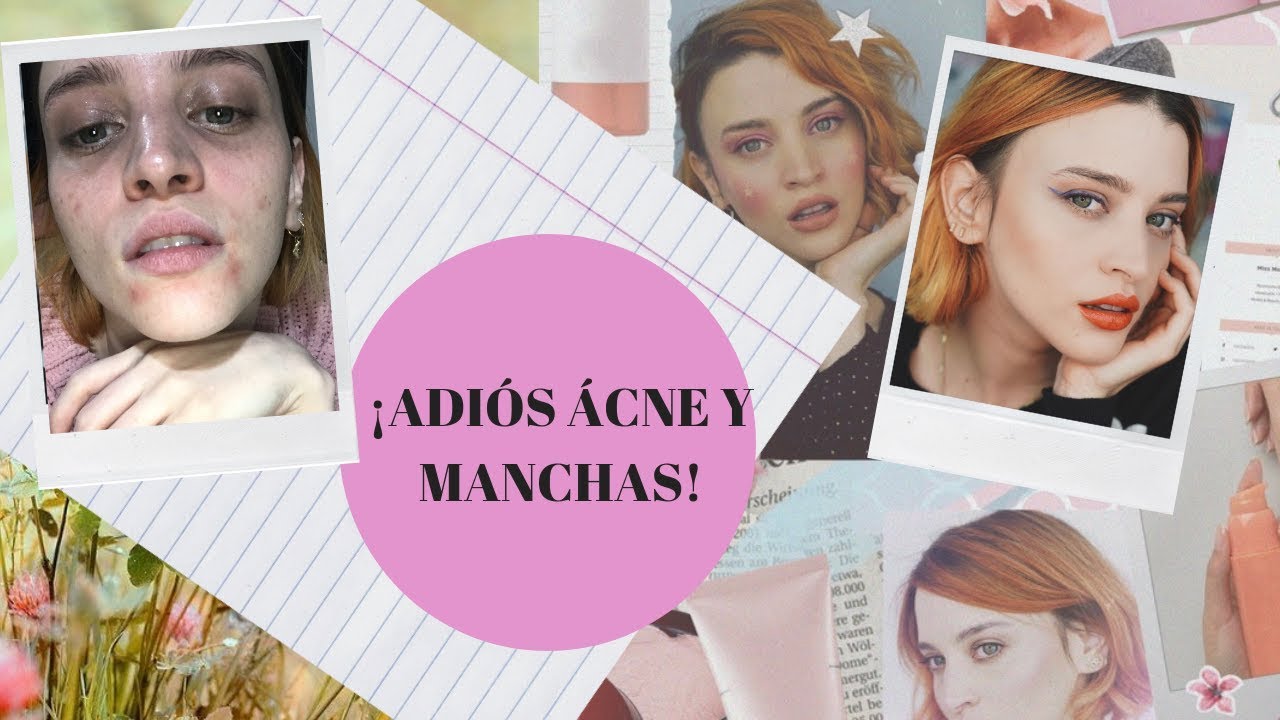 aceite arbol de te cicatrices acne