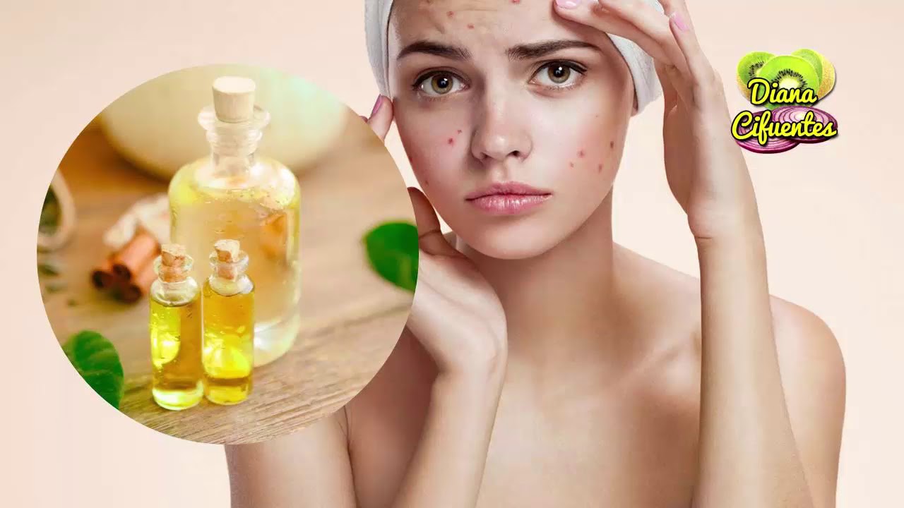 aceite de arbol de te candidiasis