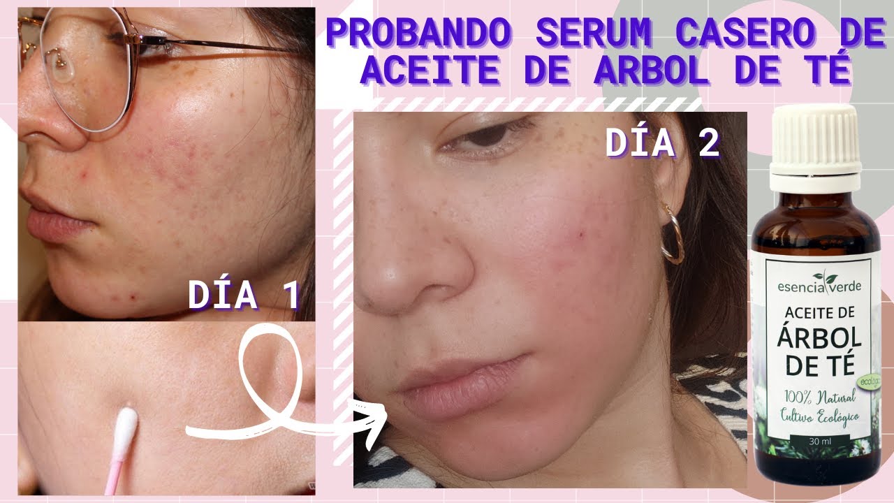 aceite de arbol de te para el acne