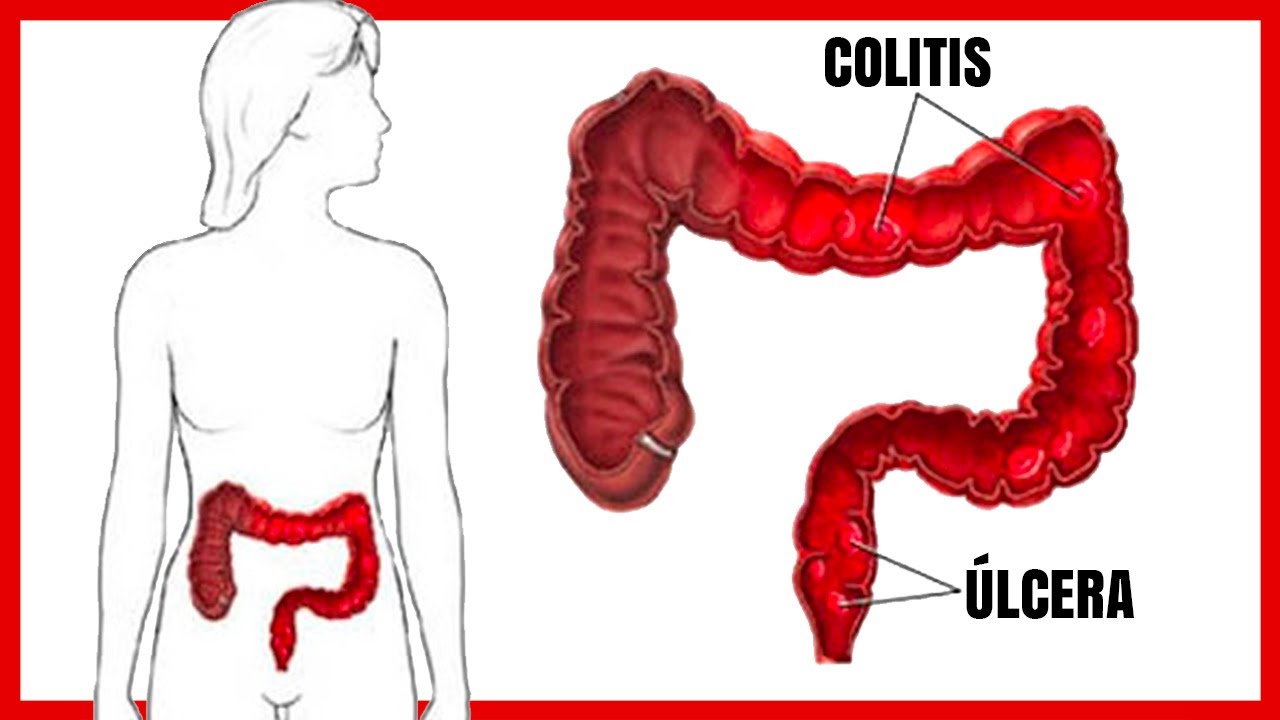 remedios naturales para la colitis ulcerosa